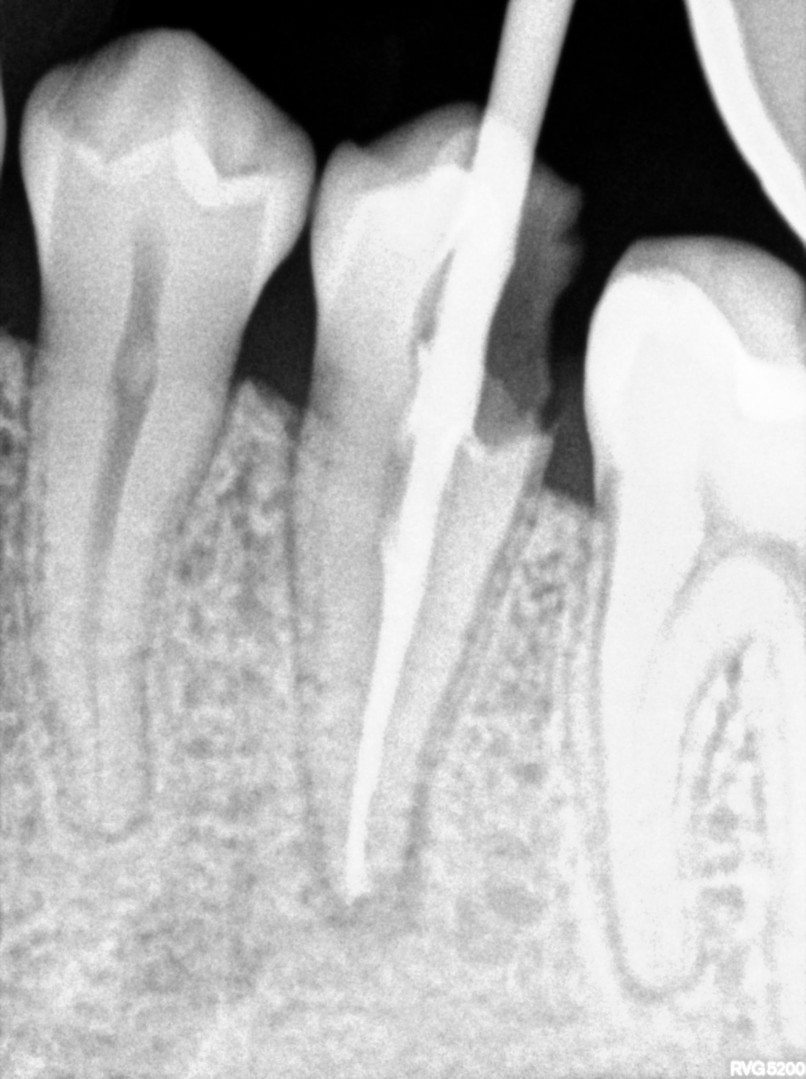 Dental X-ray